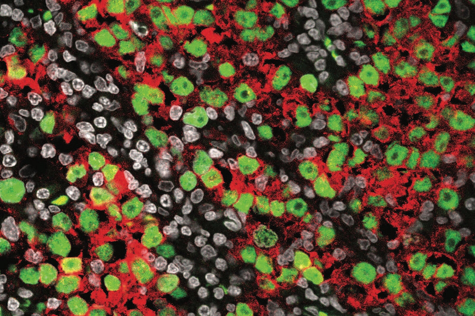 seminoma tissue microscopic image